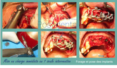 Mise en charge immédiate en 1 seule intervention la solution immédiate positdental 006 bygm4m - Eugenol