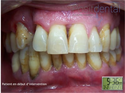 Mise en charge immédiate en chirurgie guidée   positdental 003 hmals0 - Eugenol