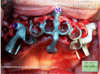 Mise en charge immédiate en chirurgie guidée   positdental 010 uubl0m - Eugenol