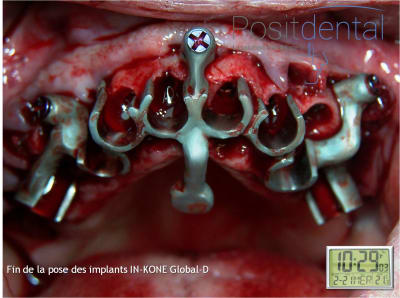 Mise en charge immédiate en chirurgie guidée   positdental 021 l2frbo - Eugenol