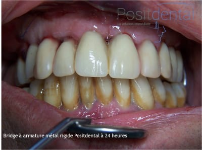 Mise en charge immédiate en chirurgie guidée   positdental 027 ebi5yn - Eugenol