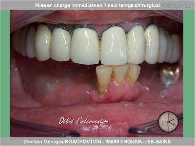 Mise en charge immédiate en chirurgie guidée positdental 001 nmscgr - Eugenol