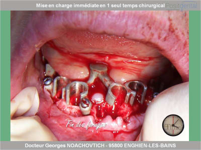 Mise en charge immédiate en chirurgie guidée positdental 005 emgvfi - Eugenol