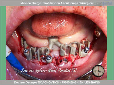 Mise en charge immédiate en chirurgie guidée positdental 006 jkzv0i - Eugenol