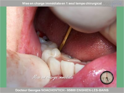 Mise en charge immédiate en chirurgie guidée positdental 007 g0usal - Eugenol