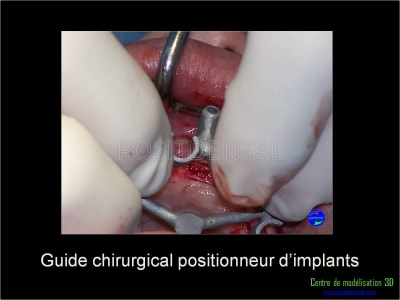 Mise en charge immédiate implant dentaire 027 n6g7ni - Eugenol