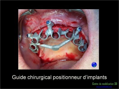 Mise en charge immédiate implant dentaire 030 gzmdcc - Eugenol