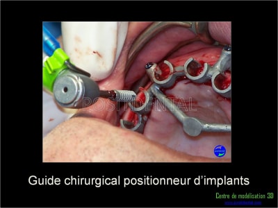 Mise en charge immédiate implant dentaire 041 jztrek - Eugenol