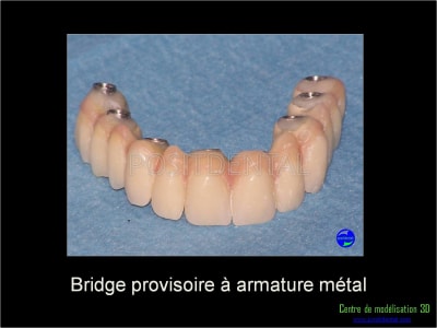 Mise en charge immédiate implant dentaire 046 vhxob0 - Eugenol