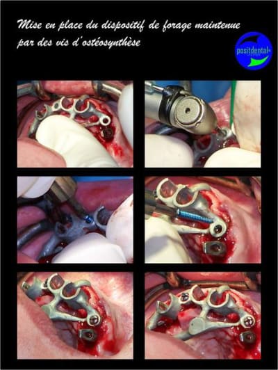 Mise en charge imm diate bridge provisoire sur implants 3 wlh5cx - Eugenol