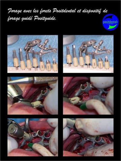 Mise en charge imm diate bridge provisoire sur implants 4 jdp7of - Eugenol