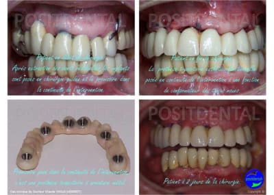 Mise en charge imm diate en chirurgie guid e positdental ioihhy - Eugenol