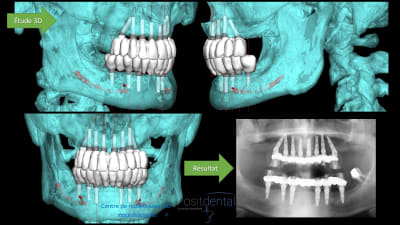 Modélisation 3d et résultat clinique hdgupg - Eugenol