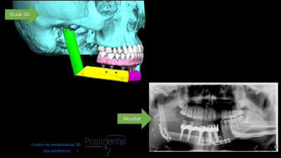 Modélisation 3d et résultat clinique ygsom6 - Eugenol