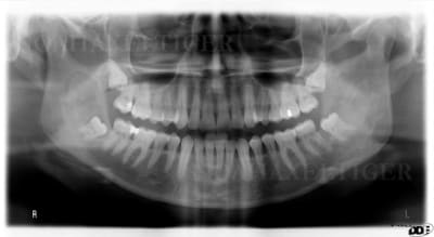 Opg 1 an apr s marsupilinisation vt10bo - Eugenol