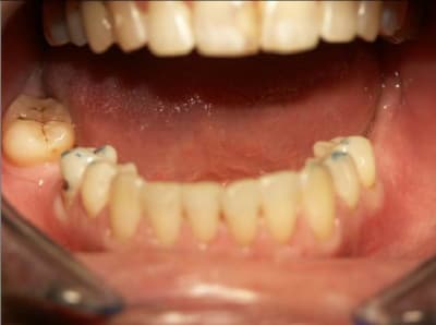 Occluso 2 shdqr2 - Eugenol