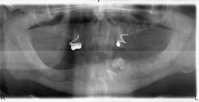 Odontome gprj0f - Eugenol