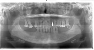 Parotex kgy7ub - Eugenol