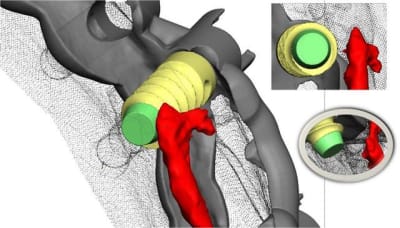 Positdental 6 naobre - Eugenol