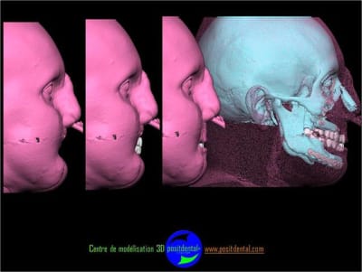 Positdental 7 sqneva - Eugenol