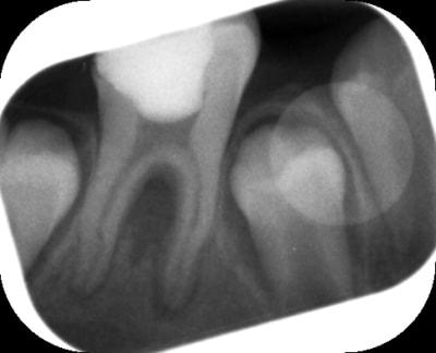 Pre op tkcn8m - Eugenol