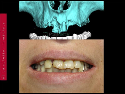 Planifiation implantaire 3d positdental 003 qsndts - Eugenol