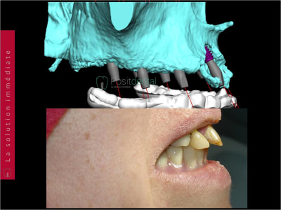 Planifiation implantaire 3d positdental 004 kkteln - Eugenol