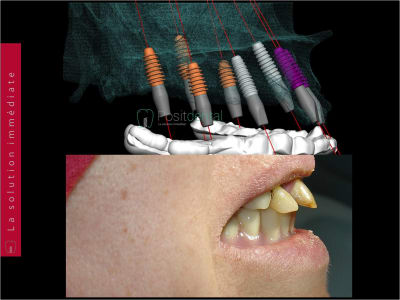 Planifiation implantaire 3d positdental 005 mireze - Eugenol