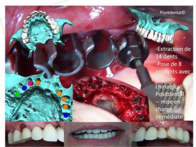 Planification 3d guide chirugical positdental  mise en charge imm diate vowpsm - Eugenol