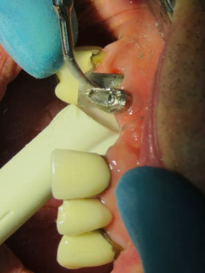 Positdental 181009 009 xs5yy0 - Eugenol