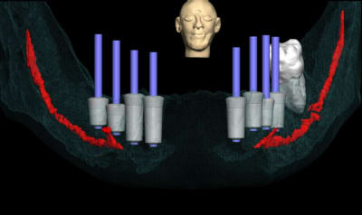 Positdental 2 nxogjm - Eugenol