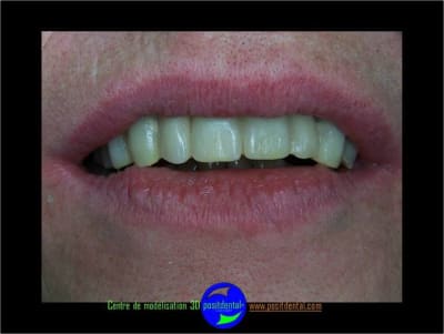 Positdental planification 3d 4 avl8uu - Eugenol