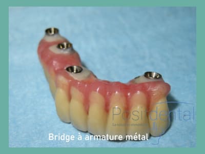 Positdental mise en charge immédiate 012 zrsxxq - Eugenol