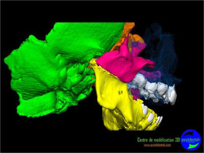 Positdental mod lisation 3d 003 orldd3 - Eugenol