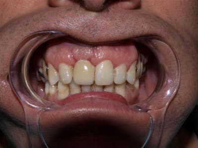 Post op 3 mois jllzwn - Eugenol