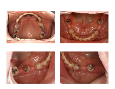 Projet implants jftzyu - Eugenol