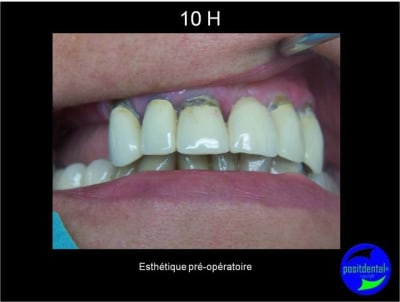 Protocole mci post extractionnelle positdental 001 nov9xm - Eugenol