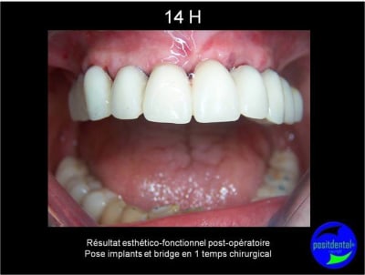 Protocole mci post extractionnelle positdental 002 xbosa2 - Eugenol
