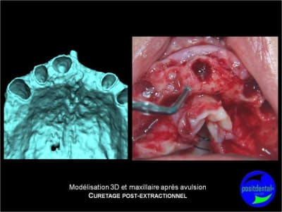 Protocole mci post extractionnelle positdental 006 t88gv8 - Eugenol