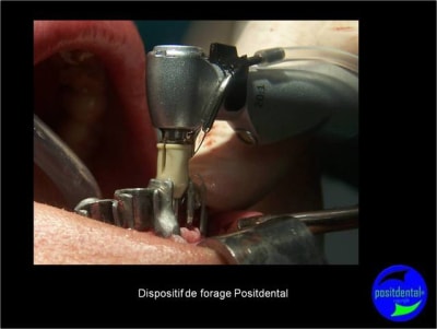 Protocole mci post extractionnelle positdental 014 uqelyq - Eugenol