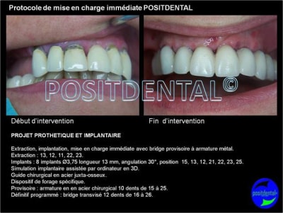 Protocole de mise en charge imm diate positdental 001 blvbwh - Eugenol