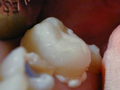 Provisoire scellée pour mettre la digue qtkmde - Eugenol