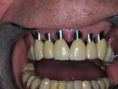 Q  83ans  re 1  xc2olf - Eugenol