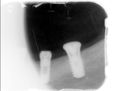 Radio implant 45 kcvglh - Eugenol