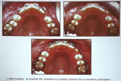 Roncone controle pixrpe - Eugenol