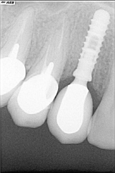 Rx implant cad 2 cpyqbp - Eugenol