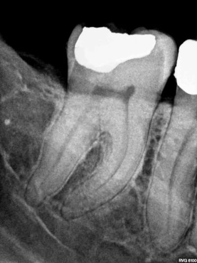 R pre op xvdxvo - Eugenol