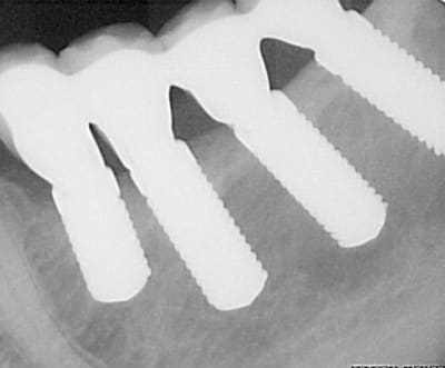 Radio bridge zircone swdtkg - Eugenol