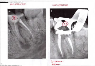 Radio pre op et post op mpan7b - Eugenol