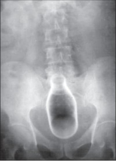 Rectal foreign body ihdyso - Eugenol